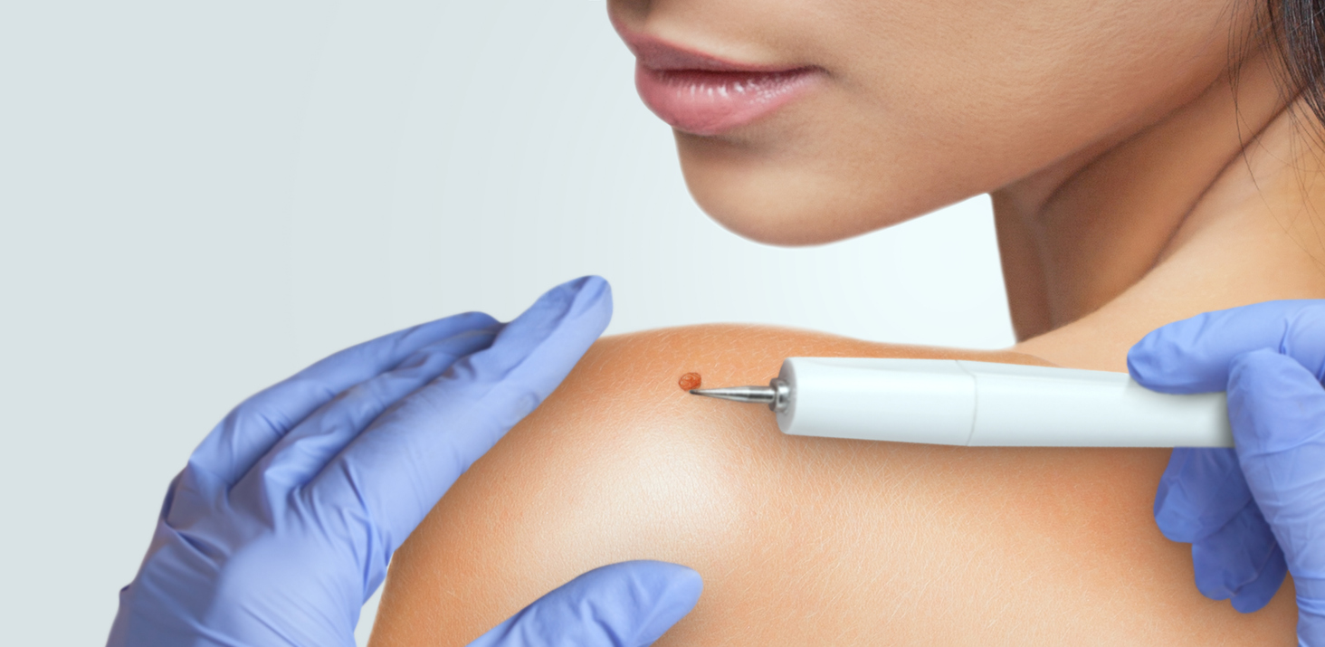 What are mole removal pens and do they work?